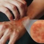 ALERGIAS Y LA NAVIDAD