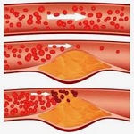 arterioesclerosis